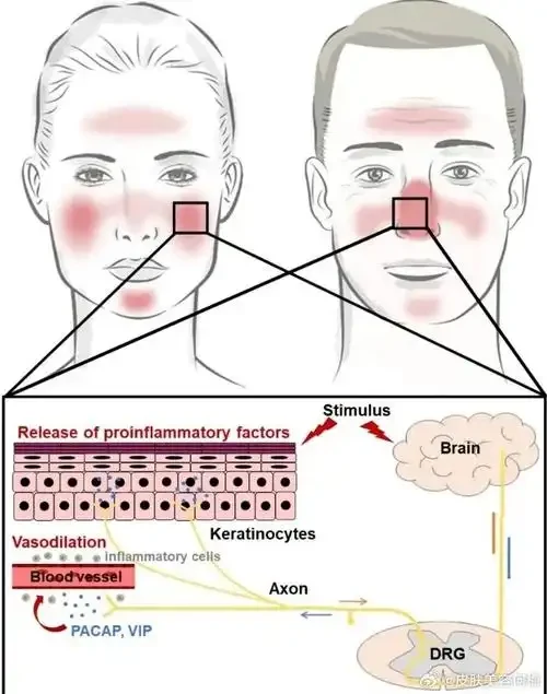 面部潮红和丘疹？你可能需要了解特应性皮炎和玫瑰痤疮！