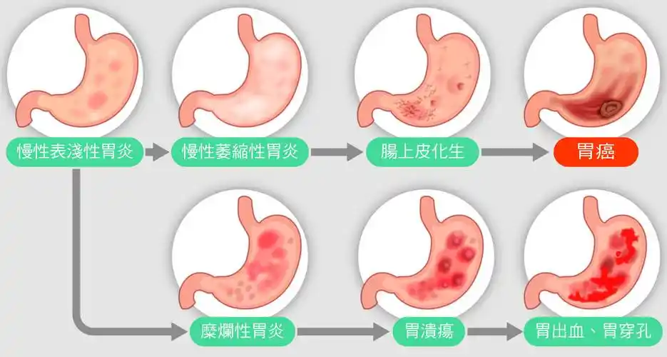 深入了解慢性胃炎：预防与治疗全指南！封面图