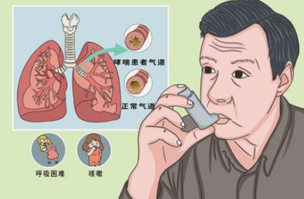 全面揭秘支气管哮喘：从诊断到治疗的完整指南封面图