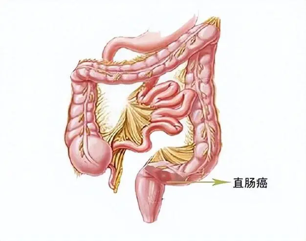 结肠癌来袭！科学防治刻不容缓