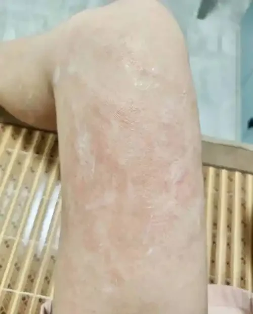 湿疹的科学探秘与健康管理 — 你需要知道的一切！