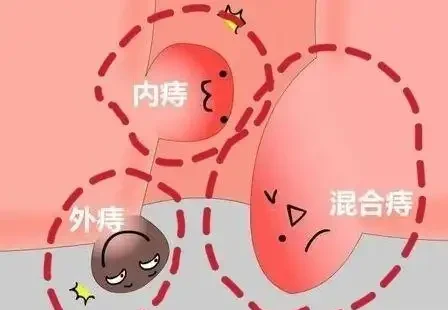 混合痔的全方位管理：从诊断到治疗
