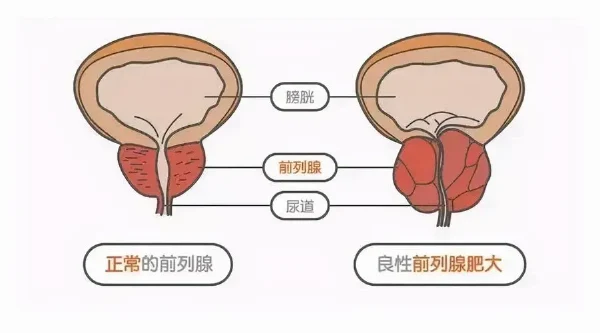 深度解析前列腺增生和膀胱结石:病因、治疗与预防全攻略