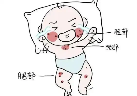 婴儿湿疹——预防与治疗的全面指南