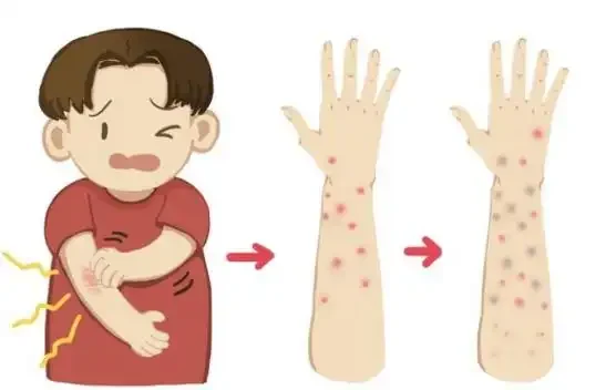 慢性荨麻疹的世界:认识它,战胜它