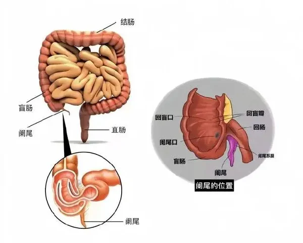 急性阑尾炎:隐藏的腹痛杀手!了解它、预防它!