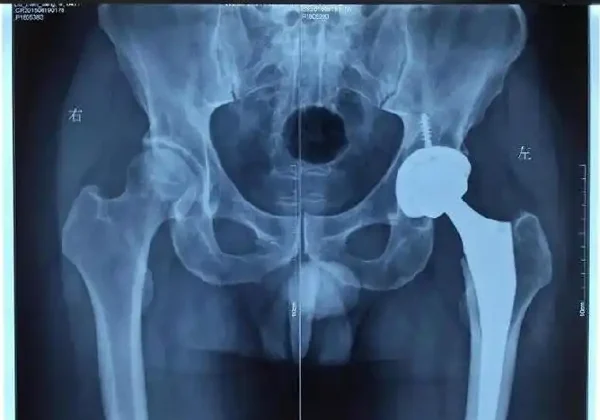 股骨头缺血性坏死:全面解读及管理策略