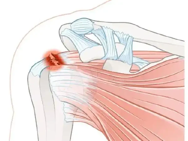 深入解析肩袖损伤：诊断与治疗