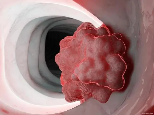 直肠腺癌的综合管理:从诊断到治疗