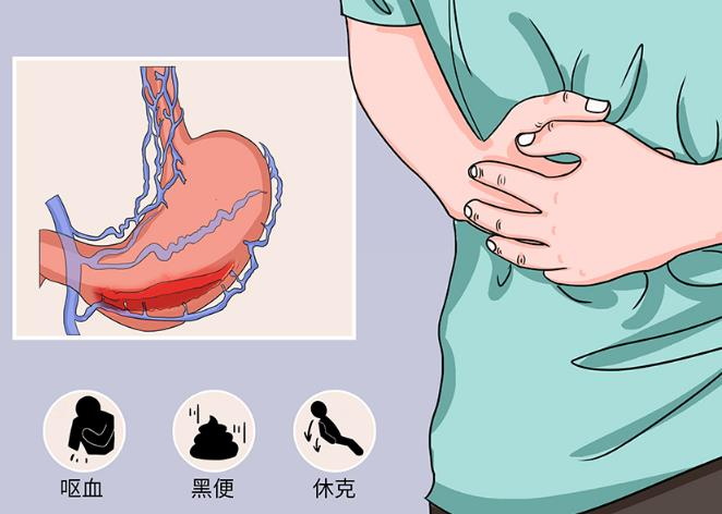 黑便四天恐示重疾！早期识别消化道出血刻不容缓