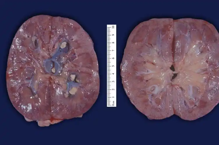 肾结石：“隐形杀手”背后的故事与对策