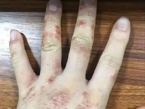 湿疹与皮肤感染——你需要了解的细节和预防方法！