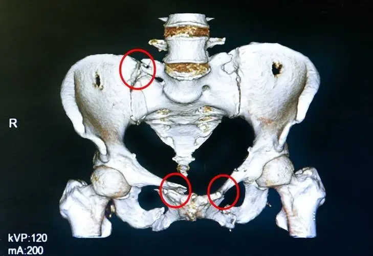 迈向健康——骨盆骨折及其治疗与预防全攻略