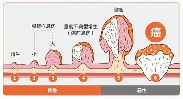 结肠息肉的全面解析：从诊断到治疗的科学管理