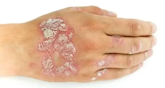 如何应对银屑病和皮炎:预防与治疗指南