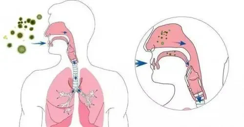上呼吸道感染:诊断、治疗与日常管理