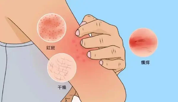 细说过敏性皮炎与常用药物治疗！——让你的皮肤恢复健康光滑！