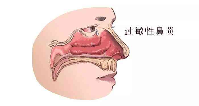 过敏性皮炎，你了解多少？——从症状到预防的全面科普