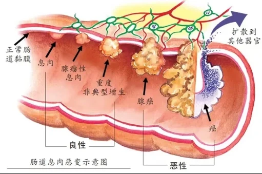 直肠癌的全面解析:从诊断到治疗