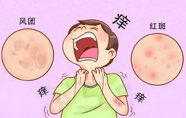 慢性荨麻疹，你了解多少？