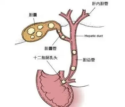 胆总管结石伴急性胆管炎的全面解读
