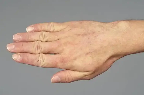 皮炎的全面解析及预防小贴士