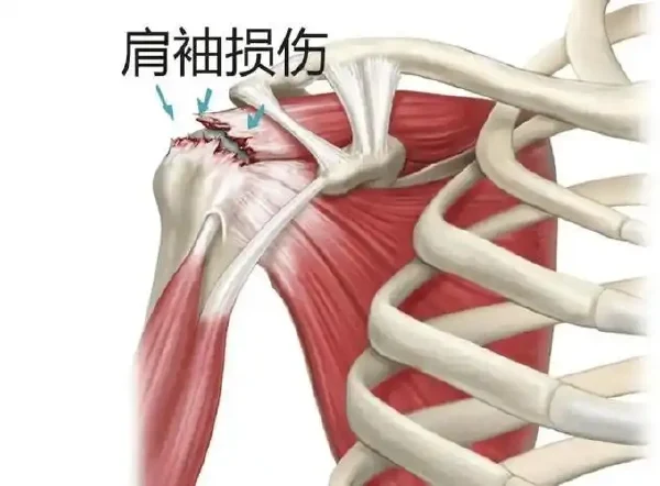 肩袖损伤——你不能忽视的常见伤病！