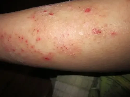 全面解析特应性皮炎的诊断与治疗