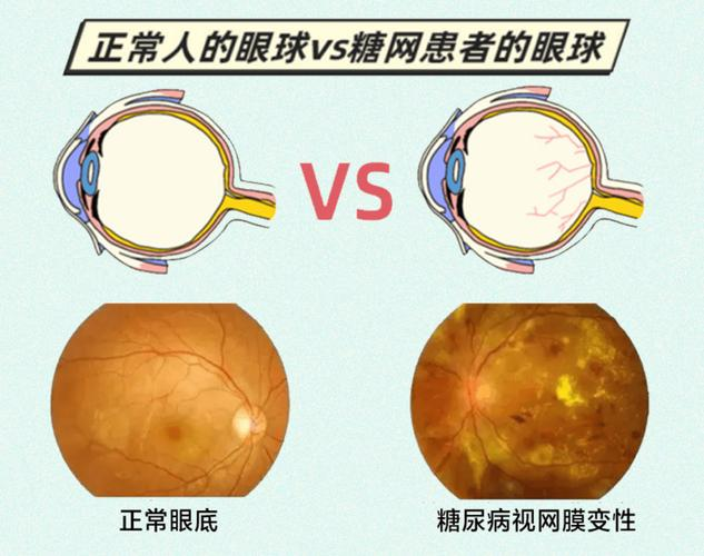 糖尿病视网膜病变及其相关疾病的预防与治疗