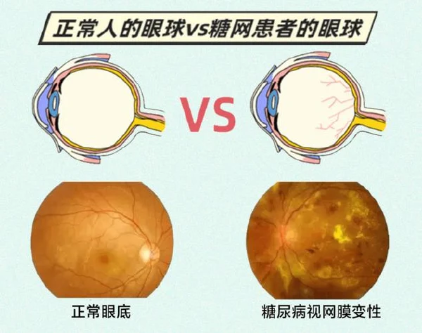糖尿病视网膜病变及其相关疾病的预防与治疗