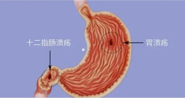 全面解析十二指肠穿孔:从诊断到治疗