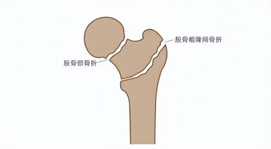 关注股骨粗隆<span style="color: #da4707">骨折</span>！老年人跌倒后不容忽视的<span style="color: #da4707">骨折</span><span style="color: #da4707">类型</span>
