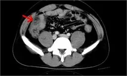 回盲部癌的全面解读:从诊断到治疗