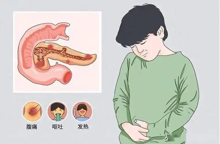 急性胰腺炎的综合诊断与治疗指南封面图