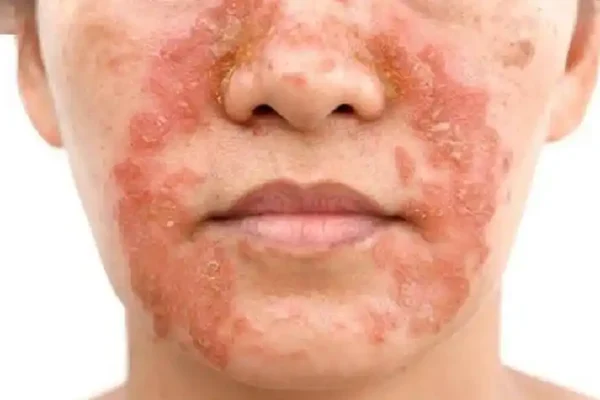 脂溢性皮炎：你可能不知道的皮肤健康敌人