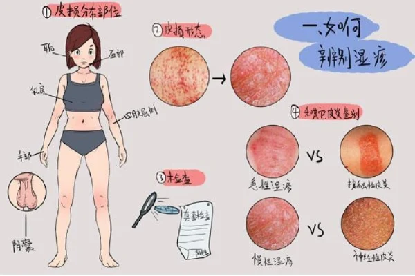 如何战胜湿疹?详尽的治疗与预防指南