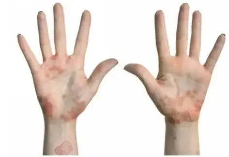 湿疹：如何应对这恼人的“皮肤痒痒虫”