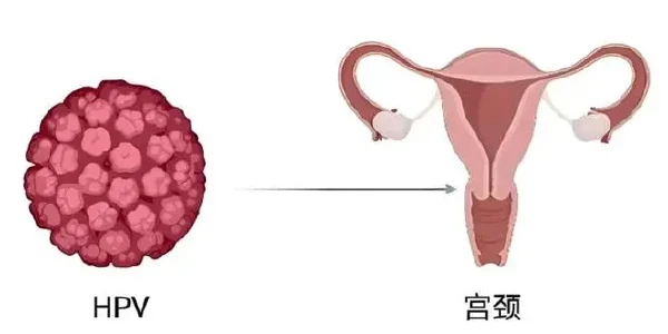 宫颈癌:从确诊到康复的全方位指南
