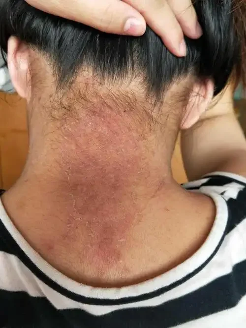 探索皮肤健康：神经性皮炎与脂溢性皮炎的治疗与预防