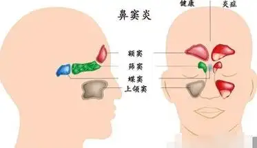 鼻窦炎不可小觑——了解症状、治疗和预防