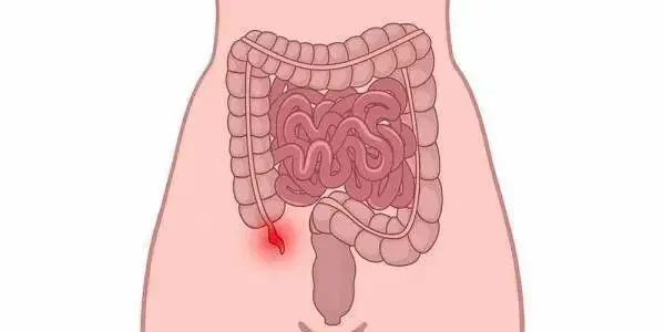 阑尾炎究竟有多可怕?别让小问题演变成大灾难!