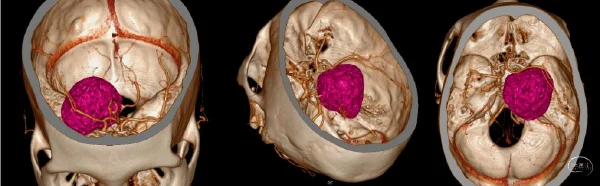 深入了解岩斜区占位性病变:诊断与治疗的科学管理