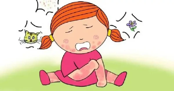 啮宦—过敏性皮炎的来龙去脉!