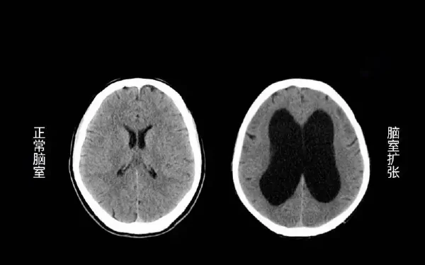 脑积水及其相关并发症的全面解析