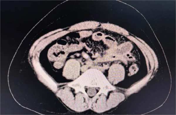 阑尾炎手术后你需要注意些什么？——术后恢复指南不容错过！