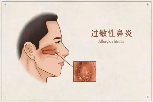 远离鼻痒喷嚏困扰：你需要了解的变应性鼻炎