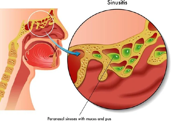 什么是肥厚性鼻炎?看这篇文章你就明白了!