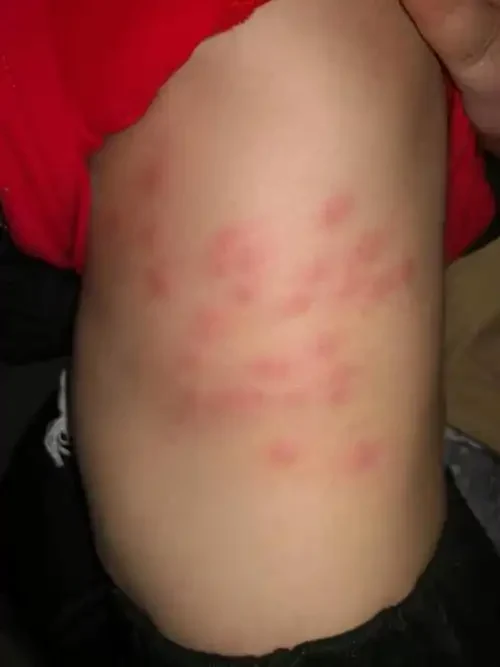 丘疹性荨麻疹：小小丘疹背后的健康警示