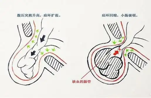 腹股沟疝的诊断与治疗：<span style="color: #da4707">科学</span>管理与个人<span style="color: #da4707">护理</span>