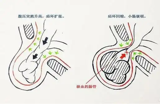 腹股沟疝的诊断与治疗：科学管理与个人护理